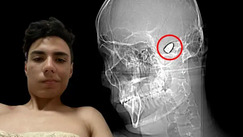 Hayatının Tehdidi: Kafasında Patlamaya Hazır Bomba Taşıyan Adam!